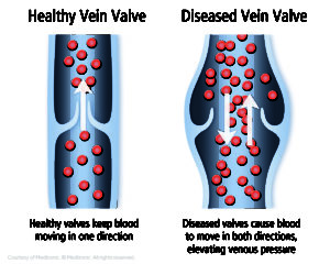 Vein Treatment Options
