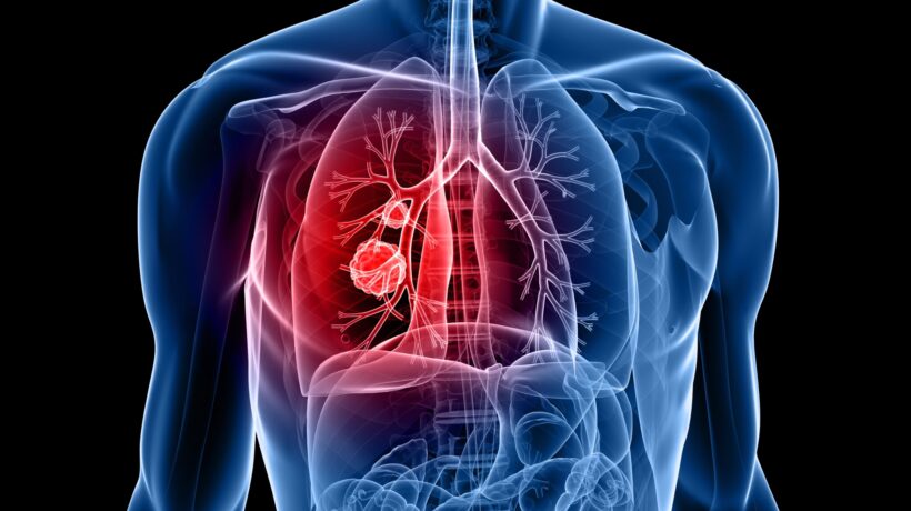Lung Cancer Screening Saves Lives