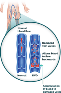 The ABCs of Vascular Disease 2