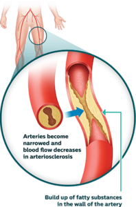 The ABCs of Vascular Disease