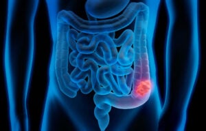 Colorectal Cancer: Preventable and Treatable, Yet Deadly 1