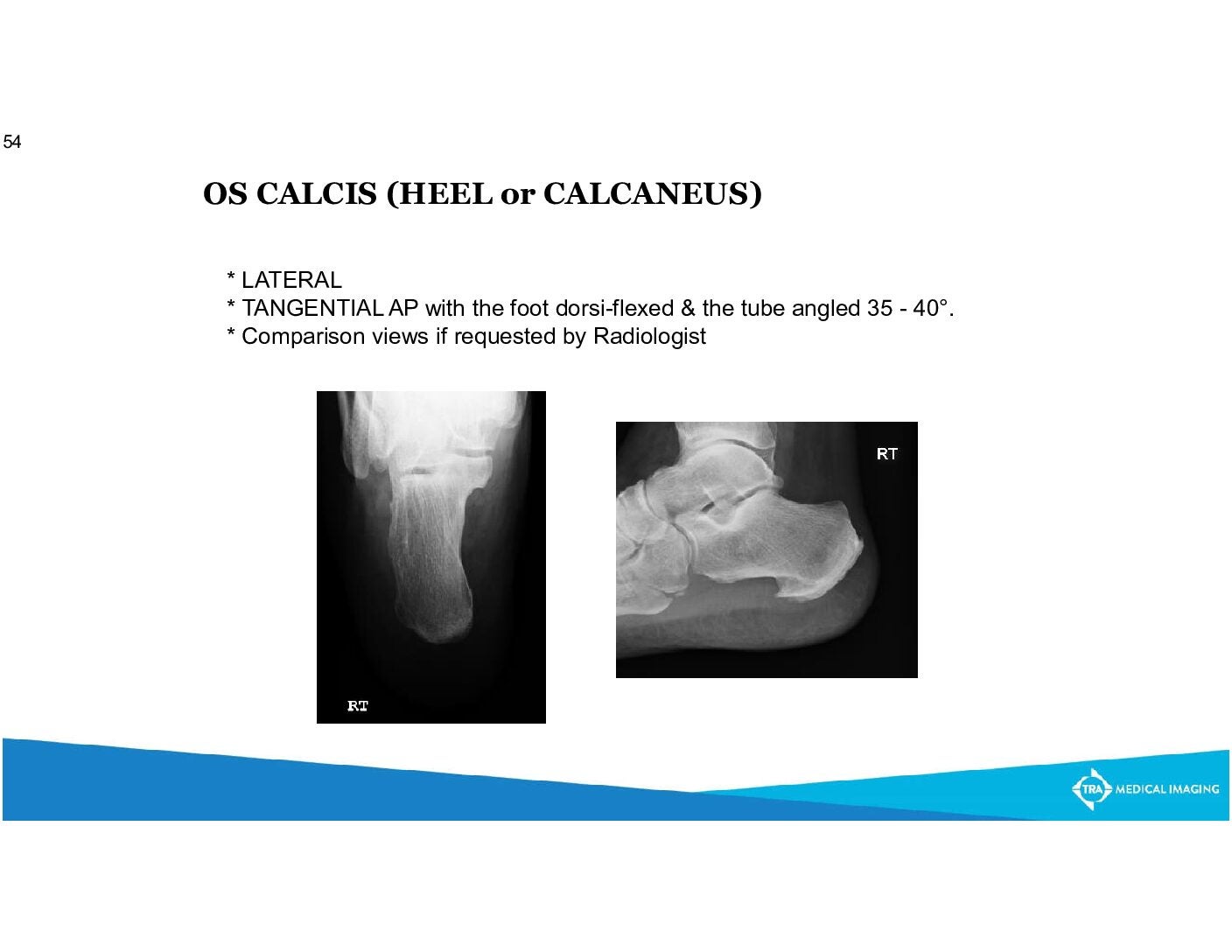 Minimally Invasive Reduction of Intraarticular Calcaneal Fractures With  Percutaneous Fixation Using Cannulated Screws Versus Kirschner Wires: A  Retrospective Comparative Study - Ahmed Shams, Osama Gamal, Mohamed Kamal  Mesregah, 2023