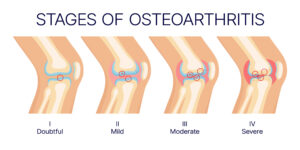 Stages of Osteoarthritis