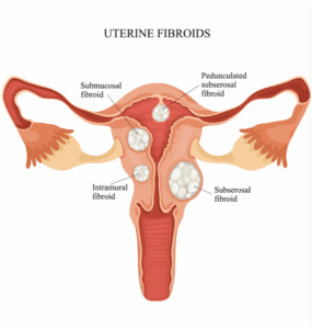 A graphic of a uterus containing fibroids