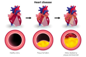 Heart disease. Coronary artery syndrome. Causes of myocardial ischemia. Atherosclerosis vector.